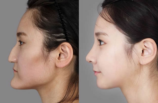 Chirurgie du menton : comment changer la forme de son visage ?