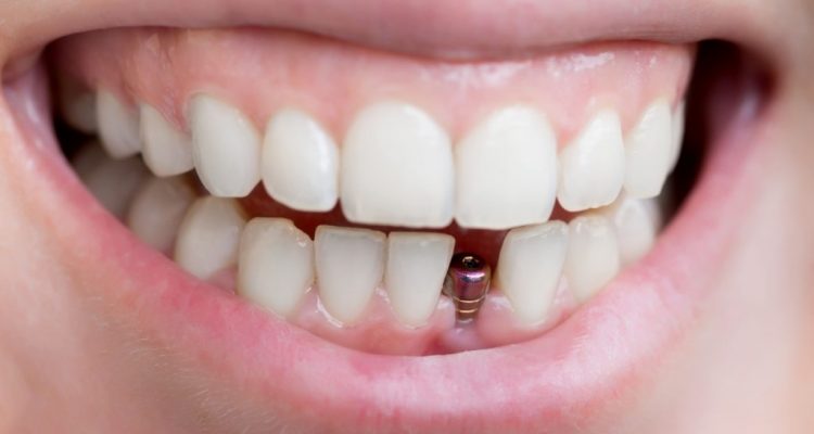 Implant dentaire Lyon : vous êtes tenté par cette solution ?