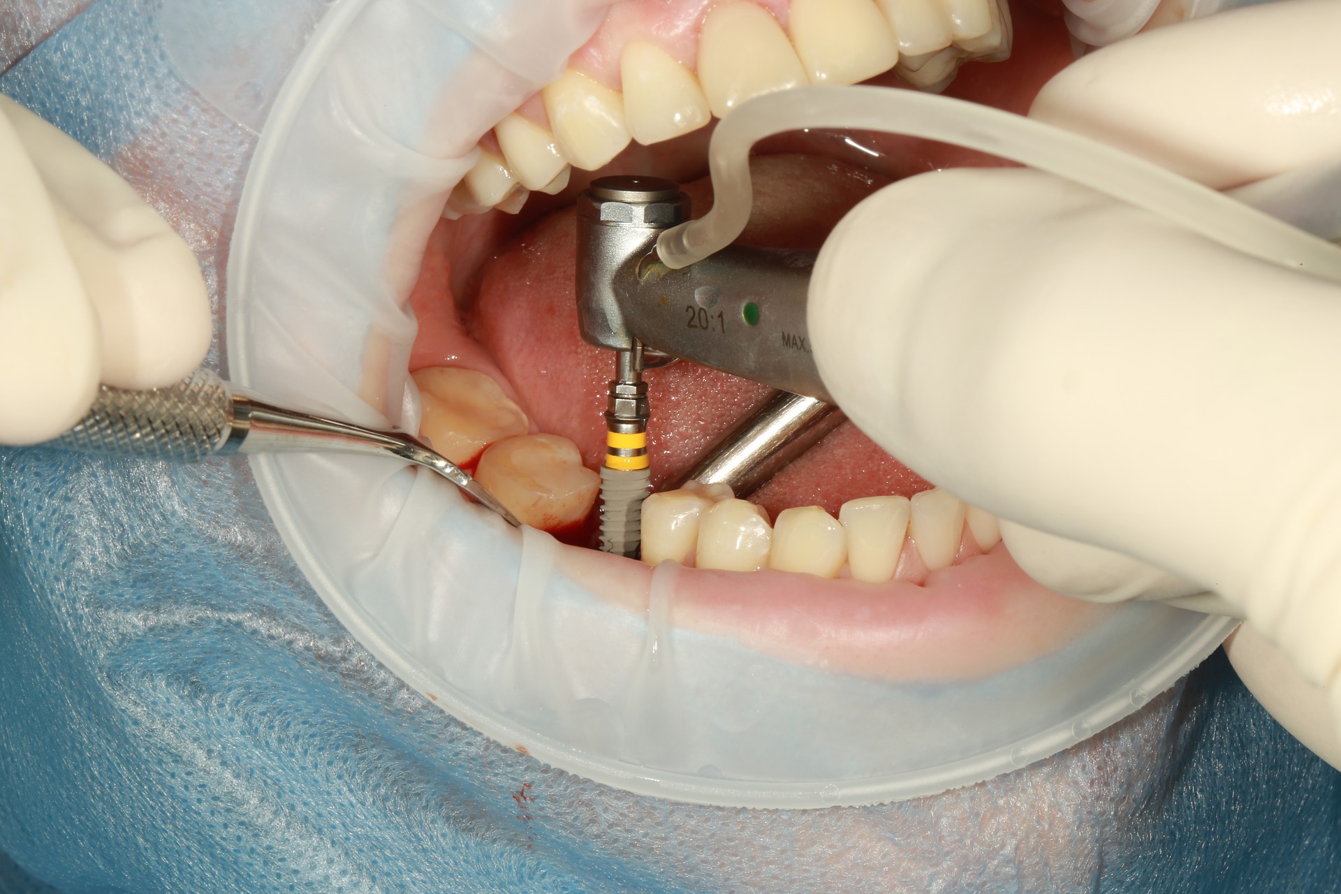 Implant dentaire Lyon : comment ça se passe ?