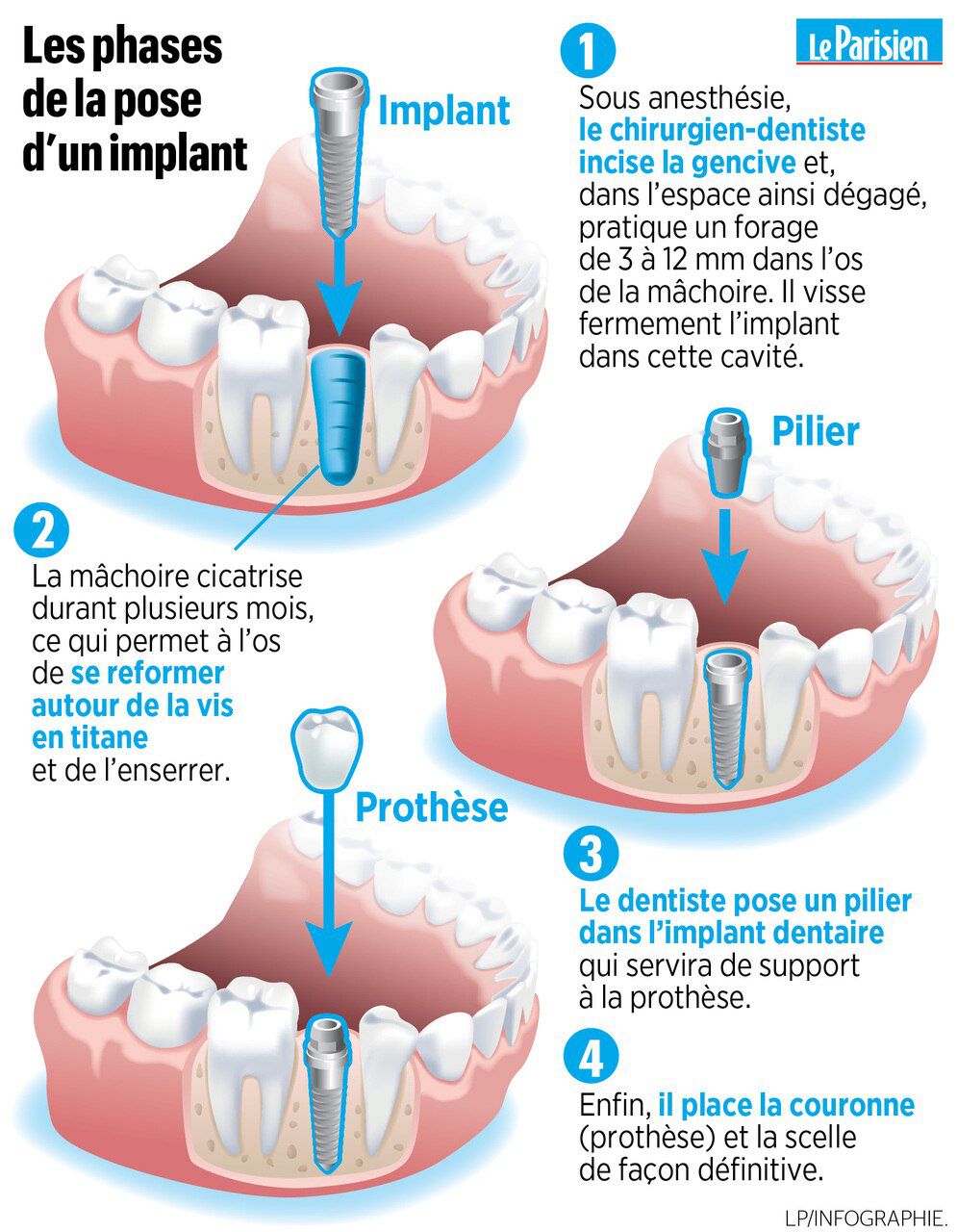 Implant dentaire Lyon : est-ce que c’est cher ?